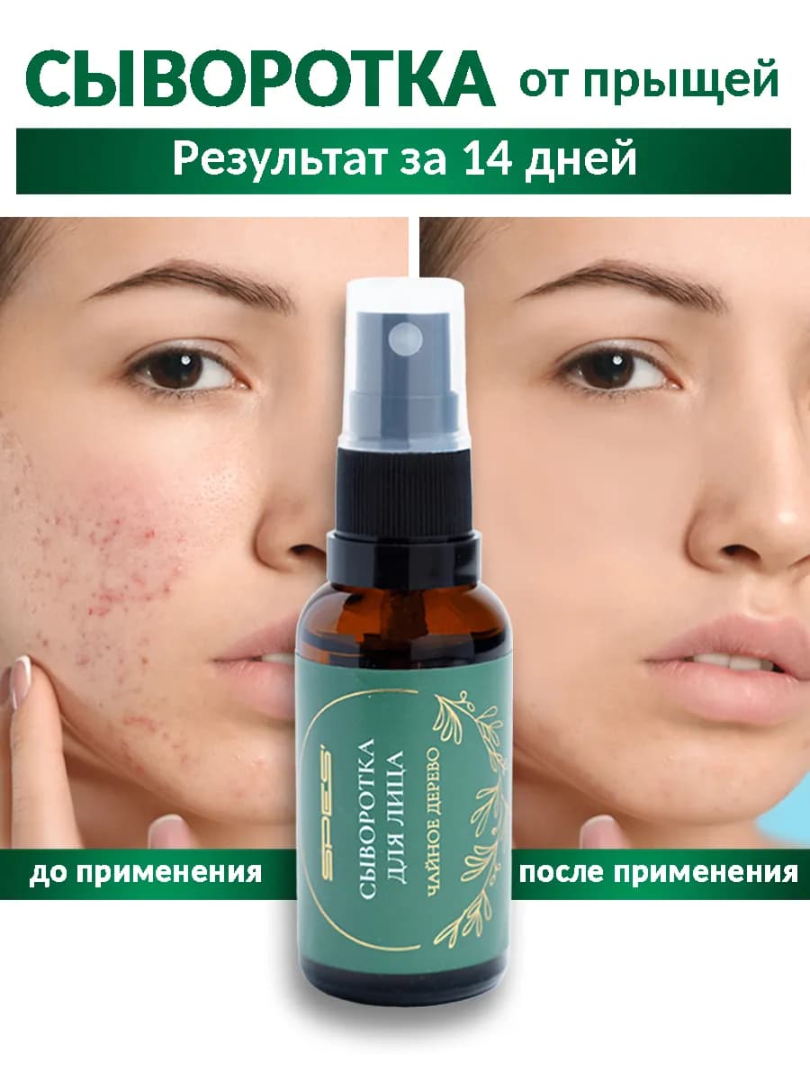 Сыворотка для лица от прыщей акне постакне